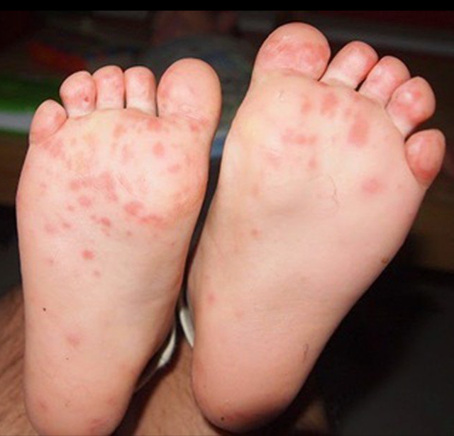 How to Deal with Rashes in Babies and Children?